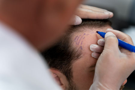 hairline-correction-image