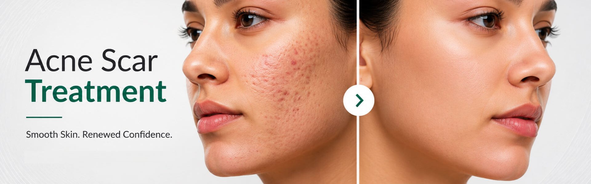 Acne Scar Image